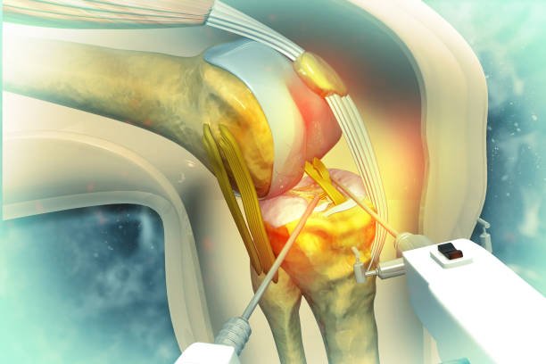 Robotic joint surgery