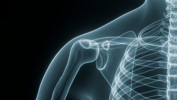 Shoulder Replacement